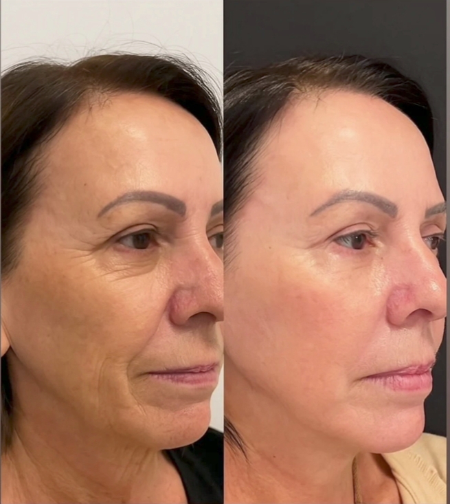 Antes e depois - Limpeza de pele