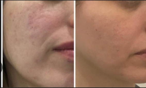 Antes e depois - Microagulhamento